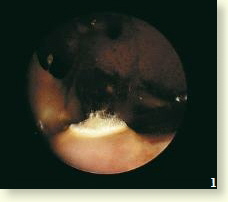 Endoskopische Aufnahme: Pilzrasen auf Leber