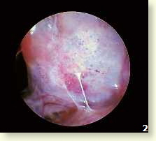 Endoskopische Aufnahme: zerstrtes Gewebe durch Aspergillus-Herde